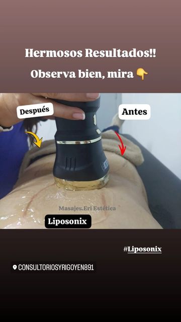Antes y después de liposucción en abdomen, con flechas señalando el cambio y texto “Hermosos resultados”