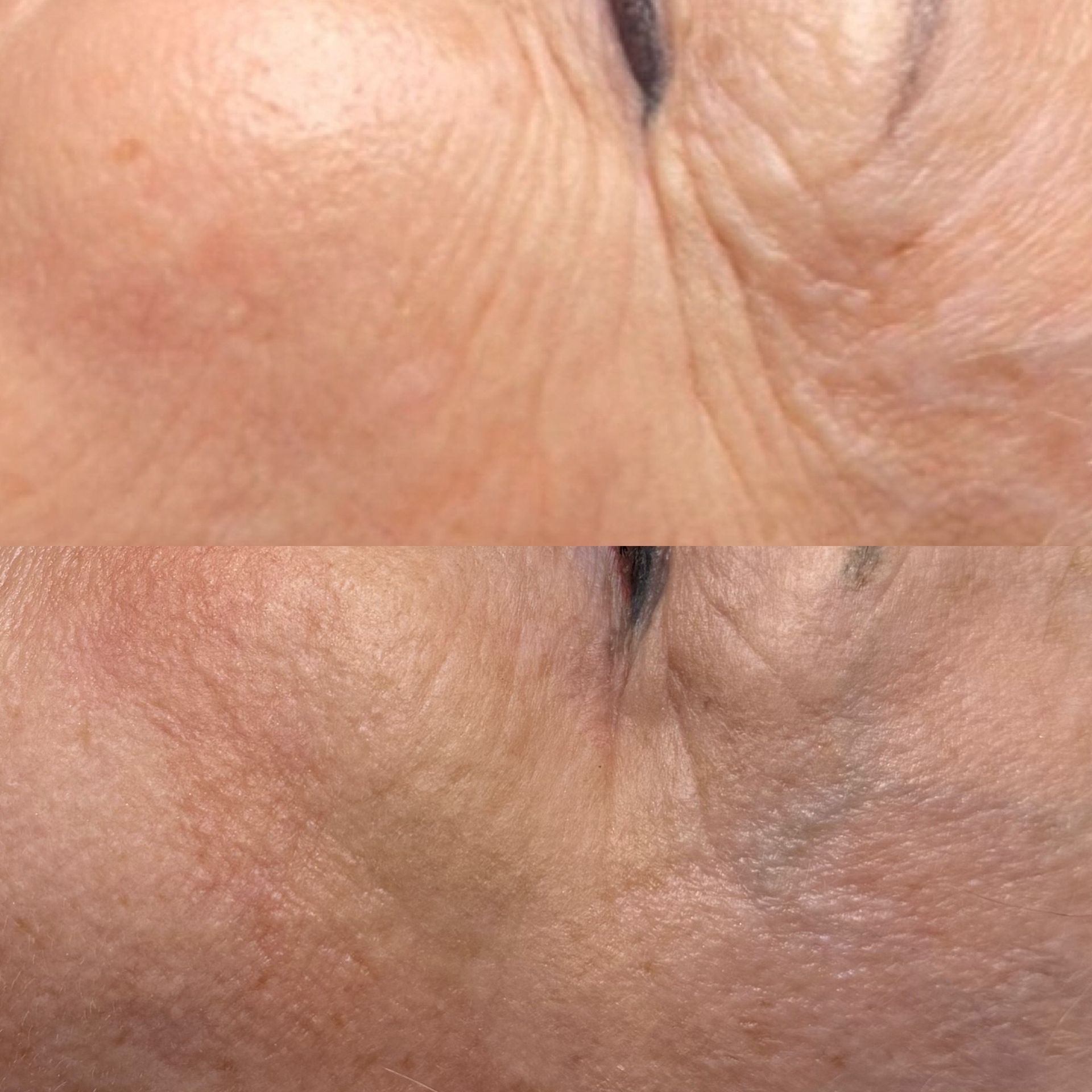 Top: Close-up of wrinkled, fair skin around eye. Bottom: Smoother skin after cosmetic treatment.