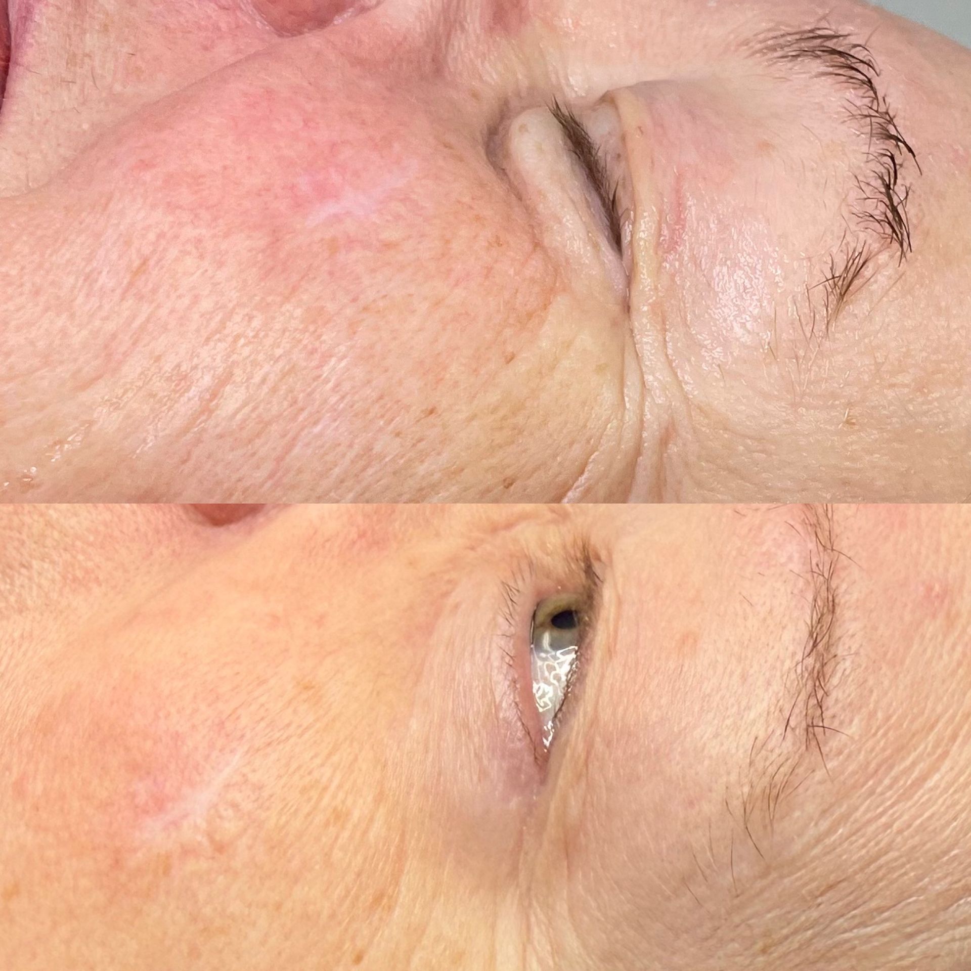 Two close-up shots of a person's face showing the eye area, possibly before and after a procedure.