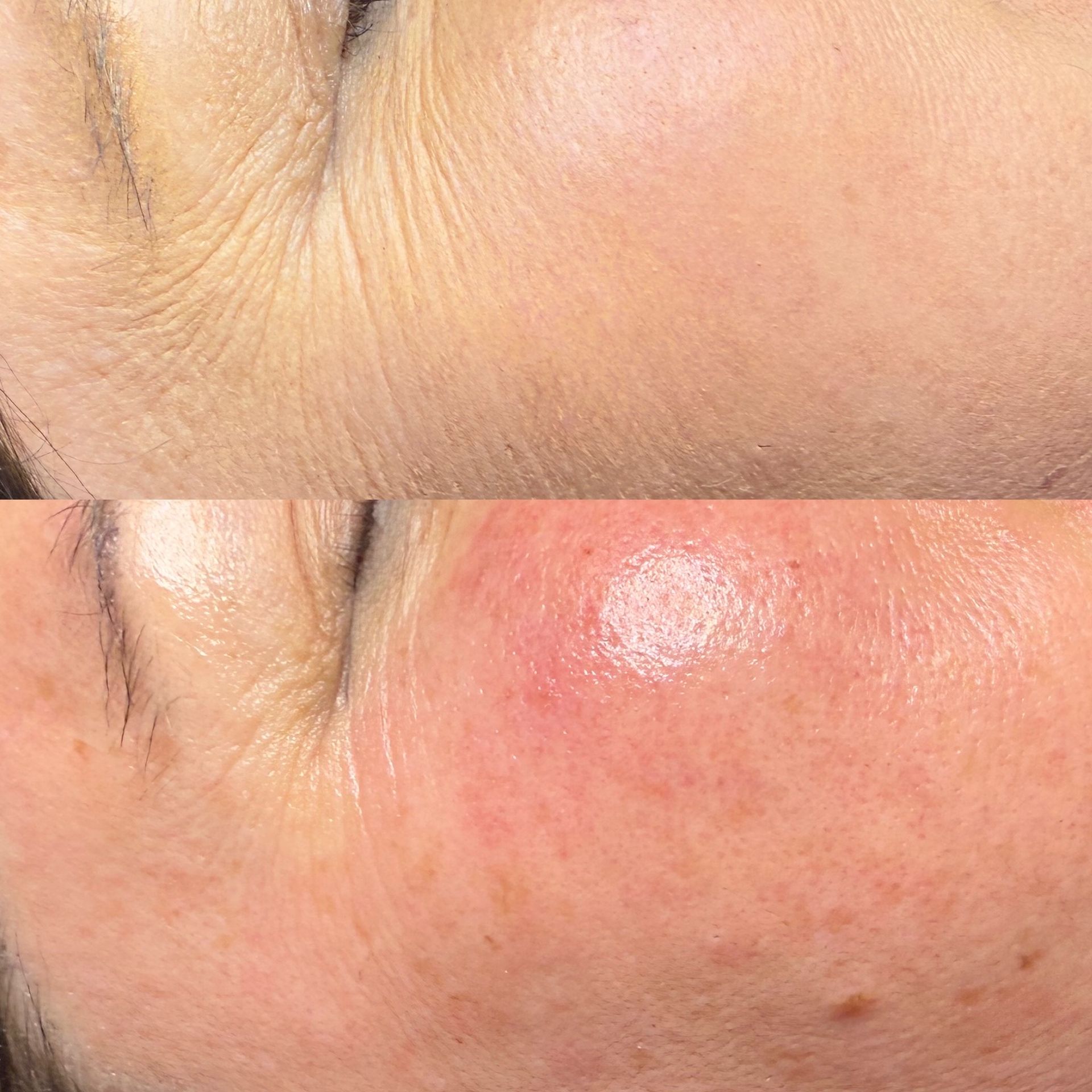 Wrinkled skin above, smooth skin below on a face, with a reddish bump on the lower cheek.