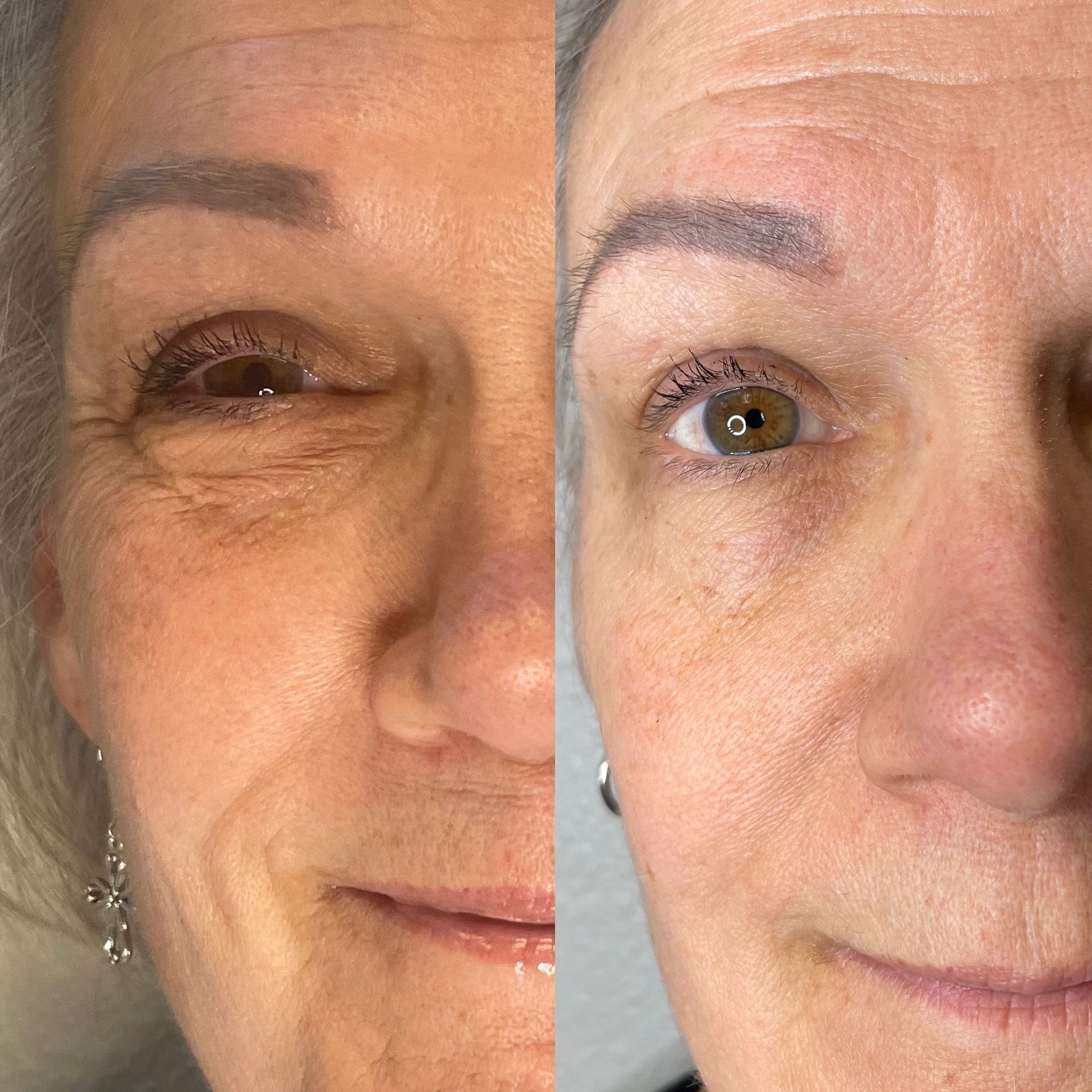 Side-by-side comparison of a woman's face: Before shows wrinkles, After shows smoother skin with improved features.