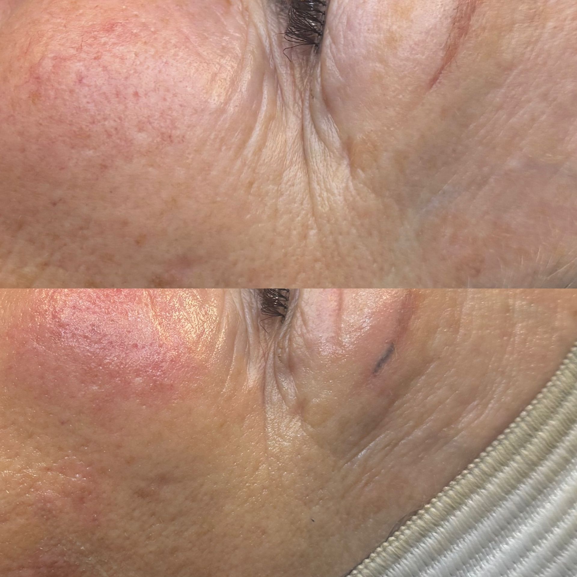 Before and after images of a person's face. Top: skin has redness and texture. Bottom: skin looks smoother, less red.