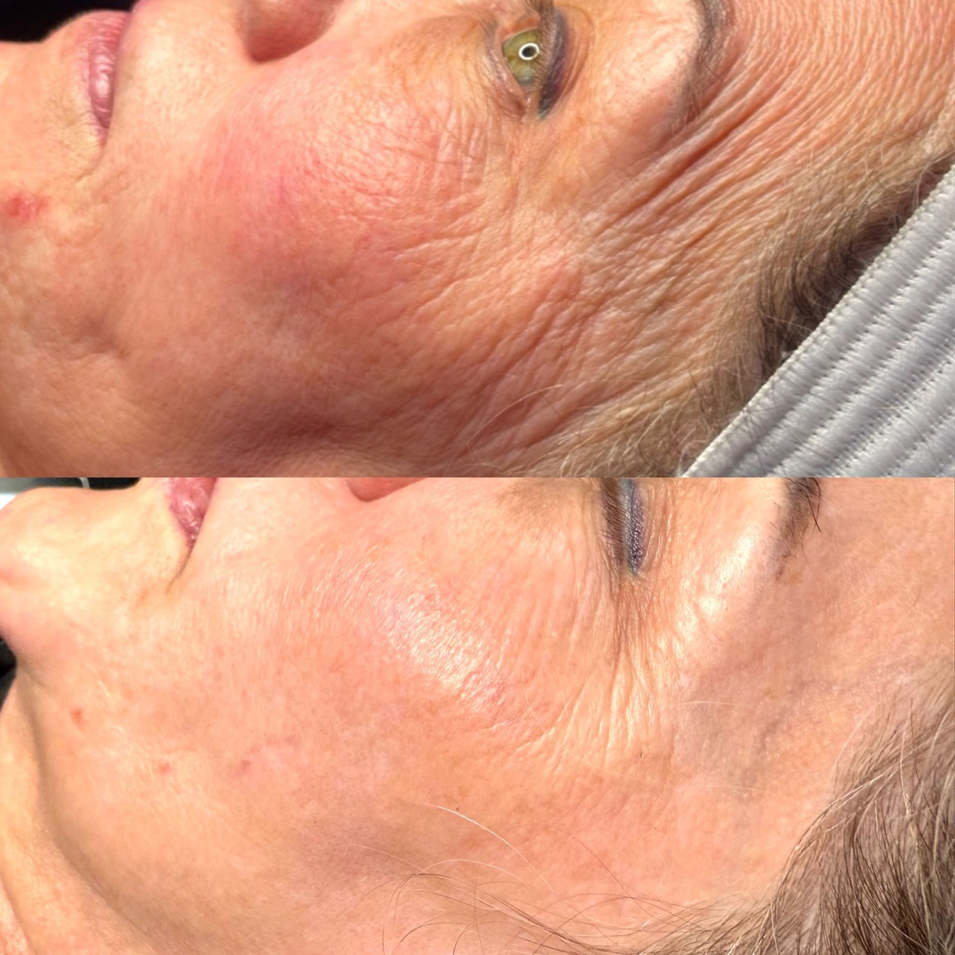 Side-by-side facial comparison: Before photo shows wrinkled skin, after photo shows improved appearance.