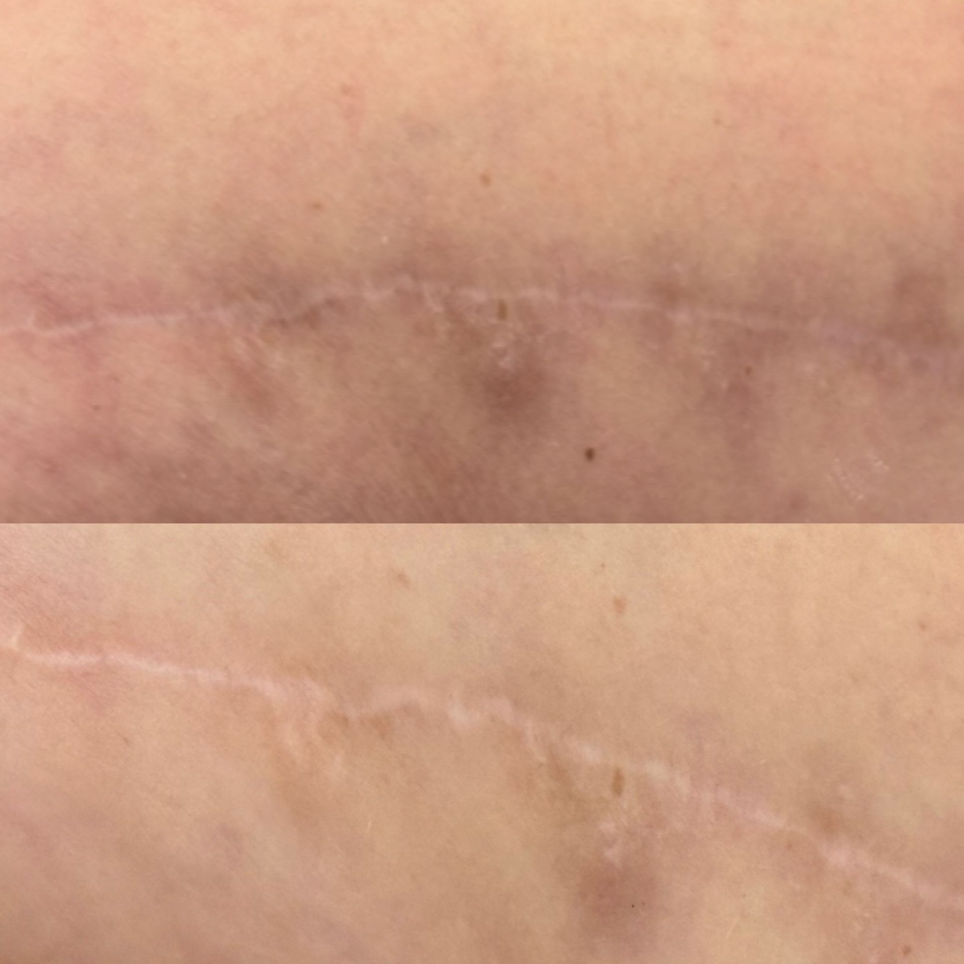 Two photos of a faded scar on skin. The scar is a thin, raised line. Skin tone is light.