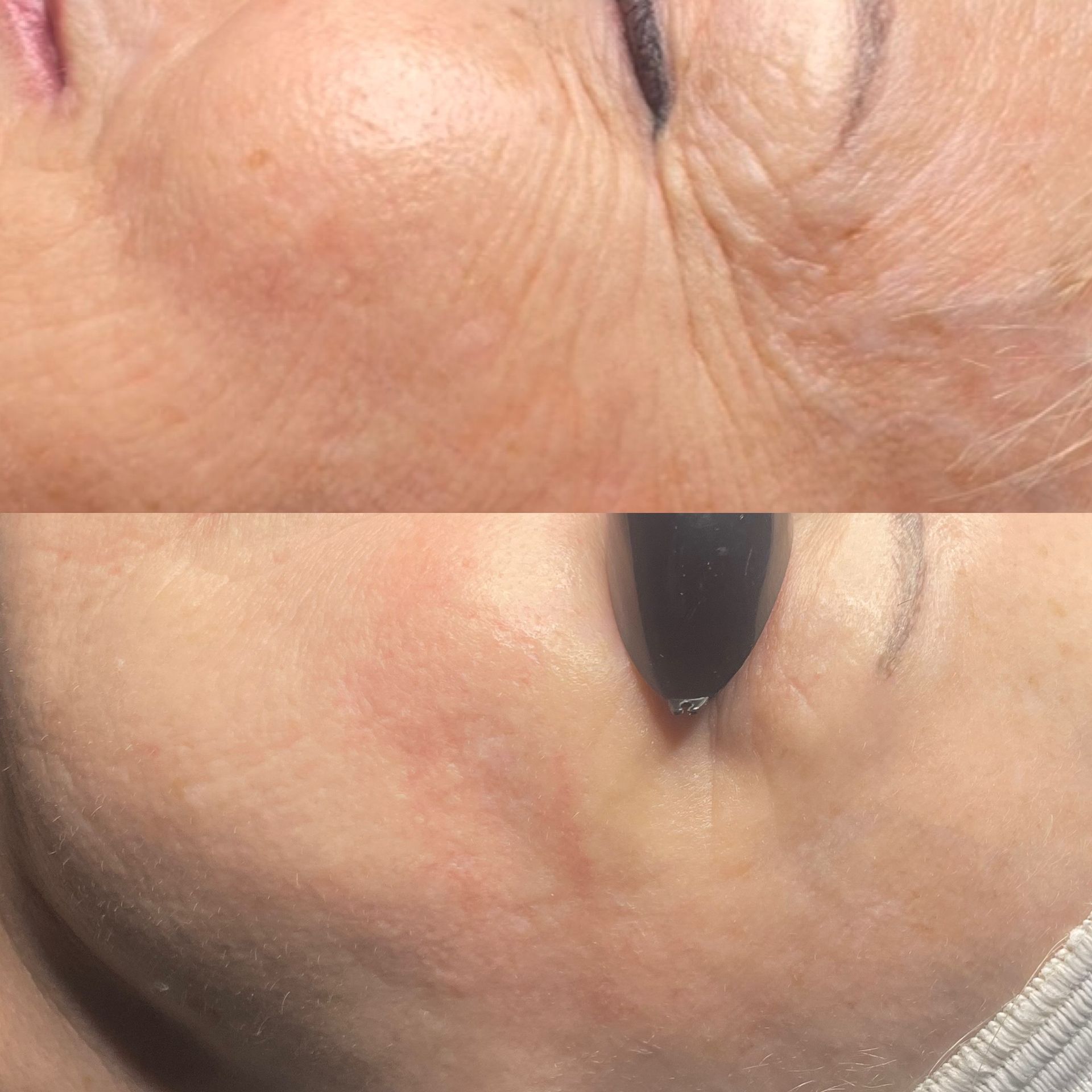 Before and after of a face, top showing wrinkles, bottom showing smoother skin after treatment.