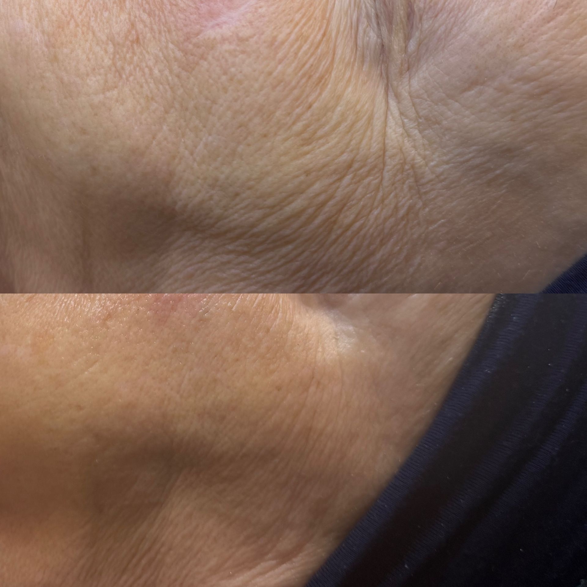 Top: Close-up of wrinkled skin. Bottom: Smoother skin, likely after treatment.