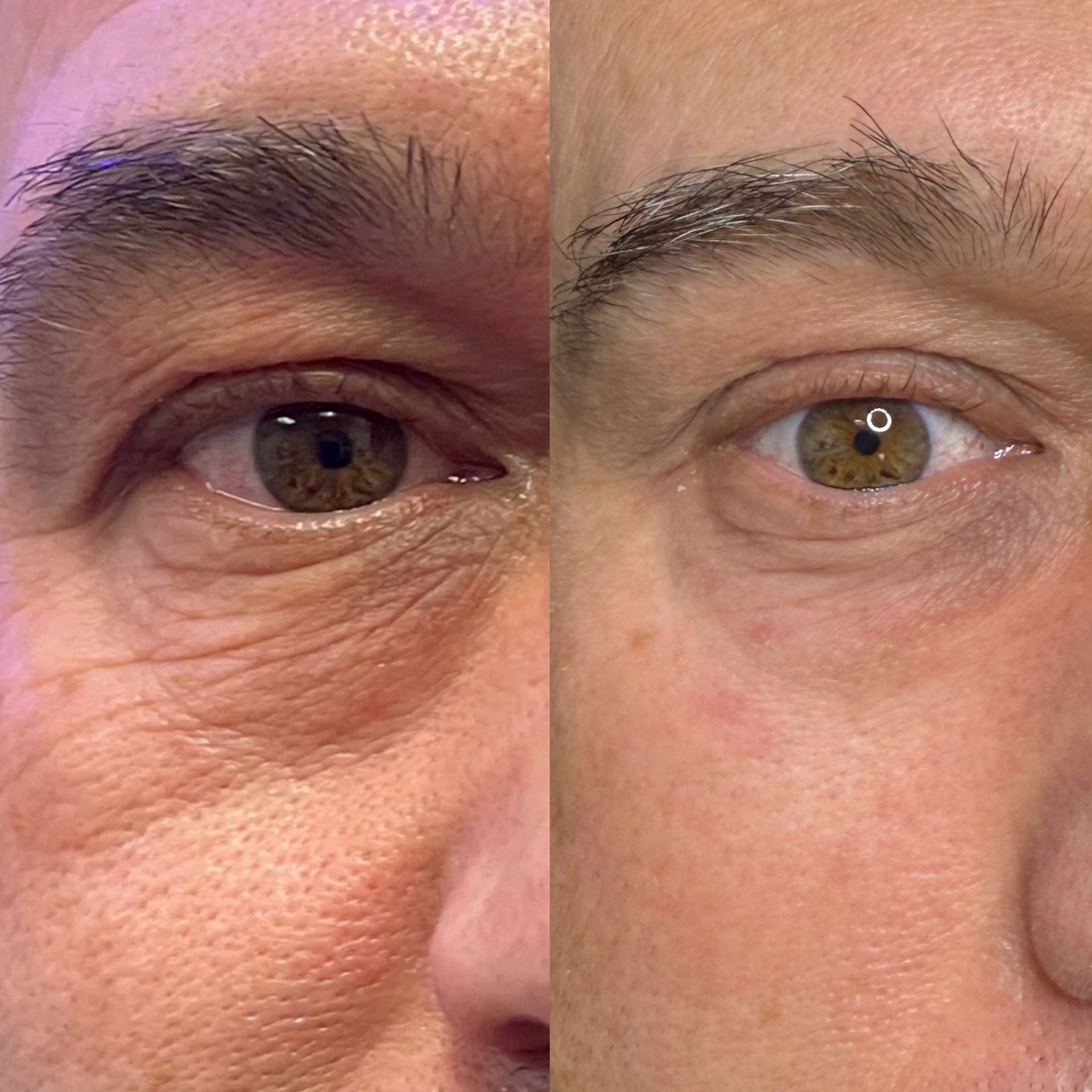 Side-by-side facial comparison of a man's eye area before (wrinkled) and after (smooth) a cosmetic procedure.