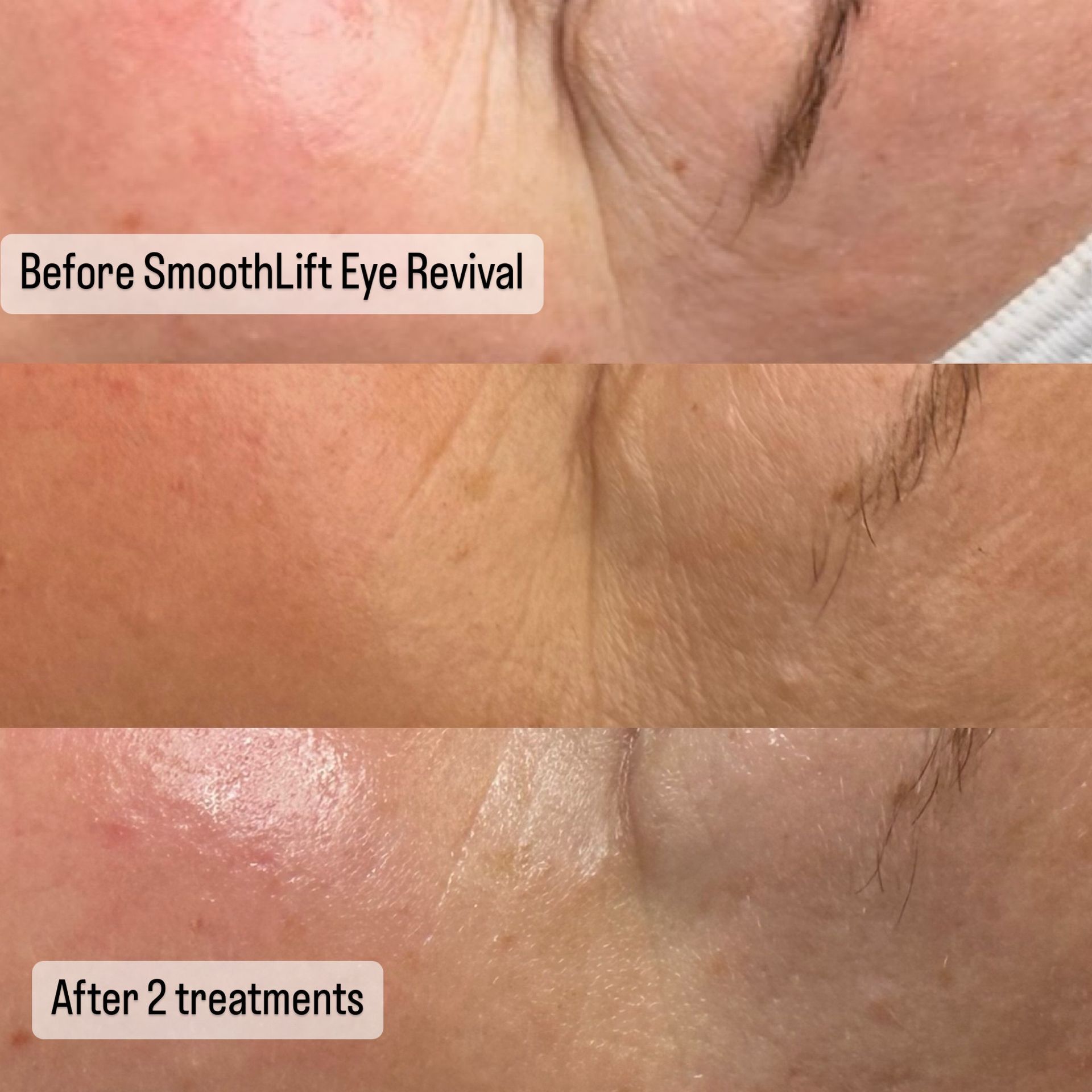 Comparison of eye wrinkles before and after two SmoothLift Eye Revival treatments.