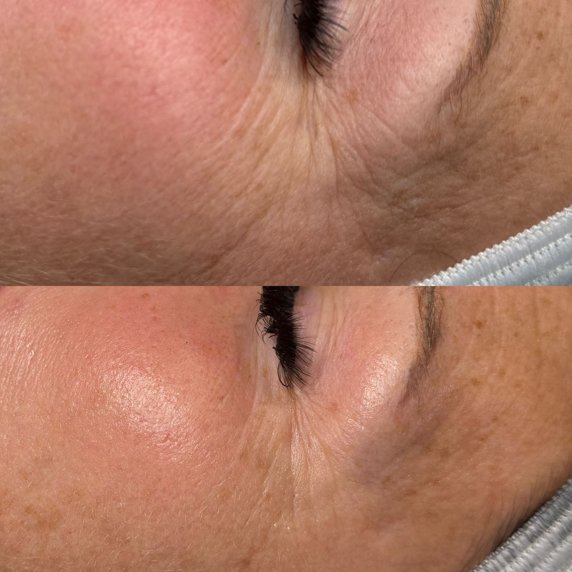 Comparison of wrinkled skin around eye before and after treatment, appearing smoother.