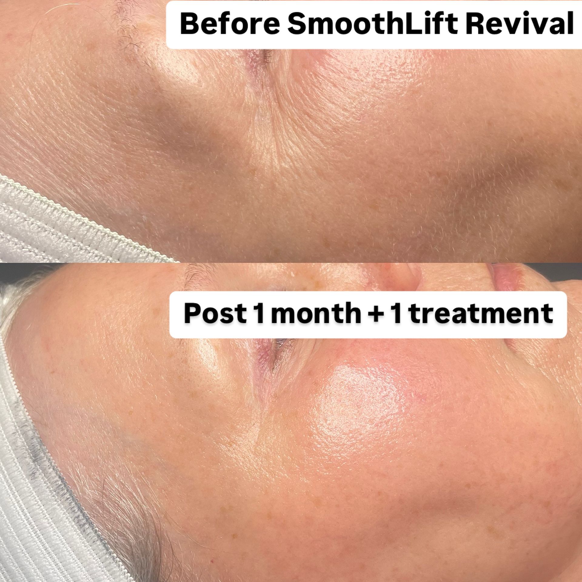 Before-and-after comparison of facial skin after SmoothLift Revival treatment; smoother skin and reduced wrinkles.