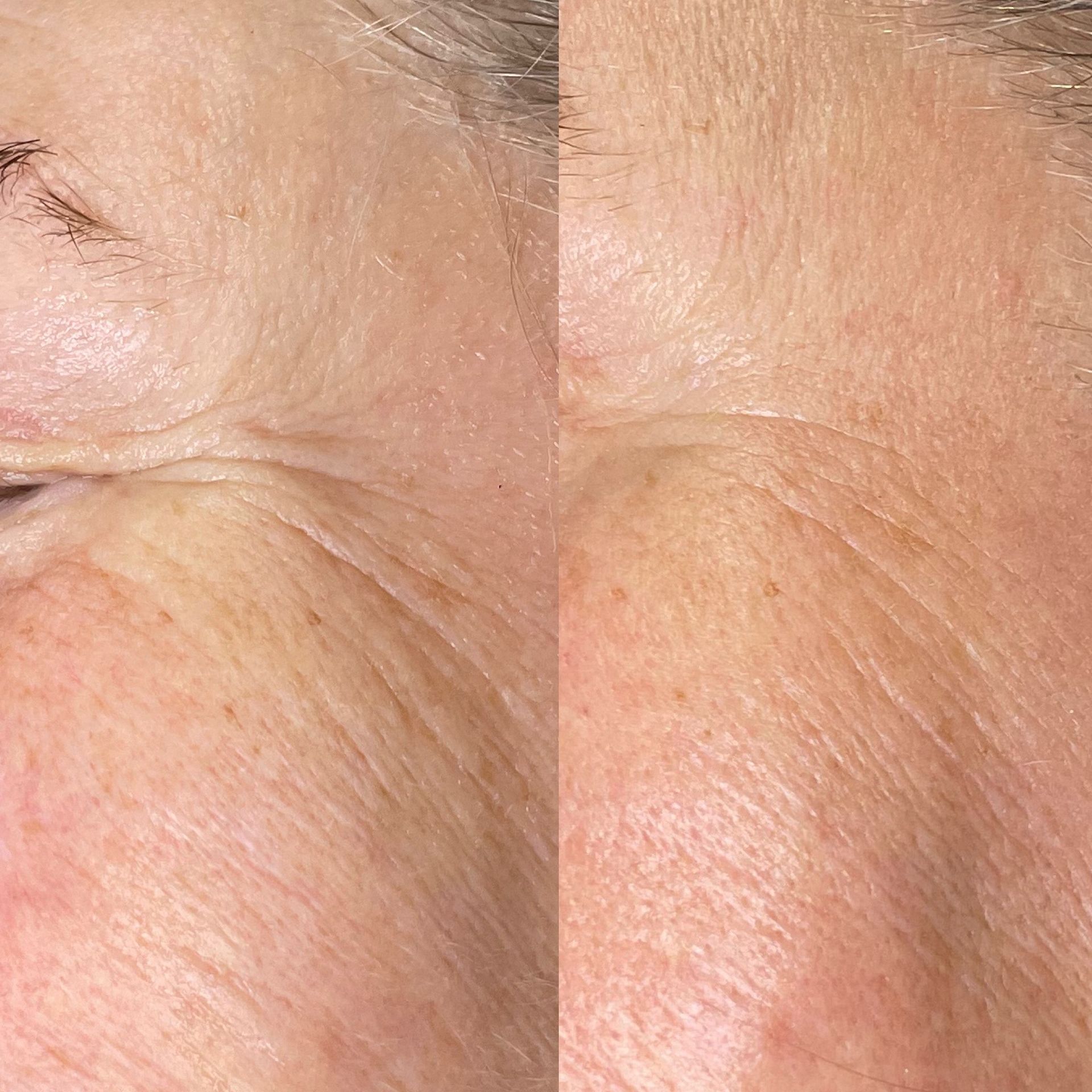 Comparison of a face showing before (left) and after (right) wrinkle reduction; skin appears smoother after treatment.