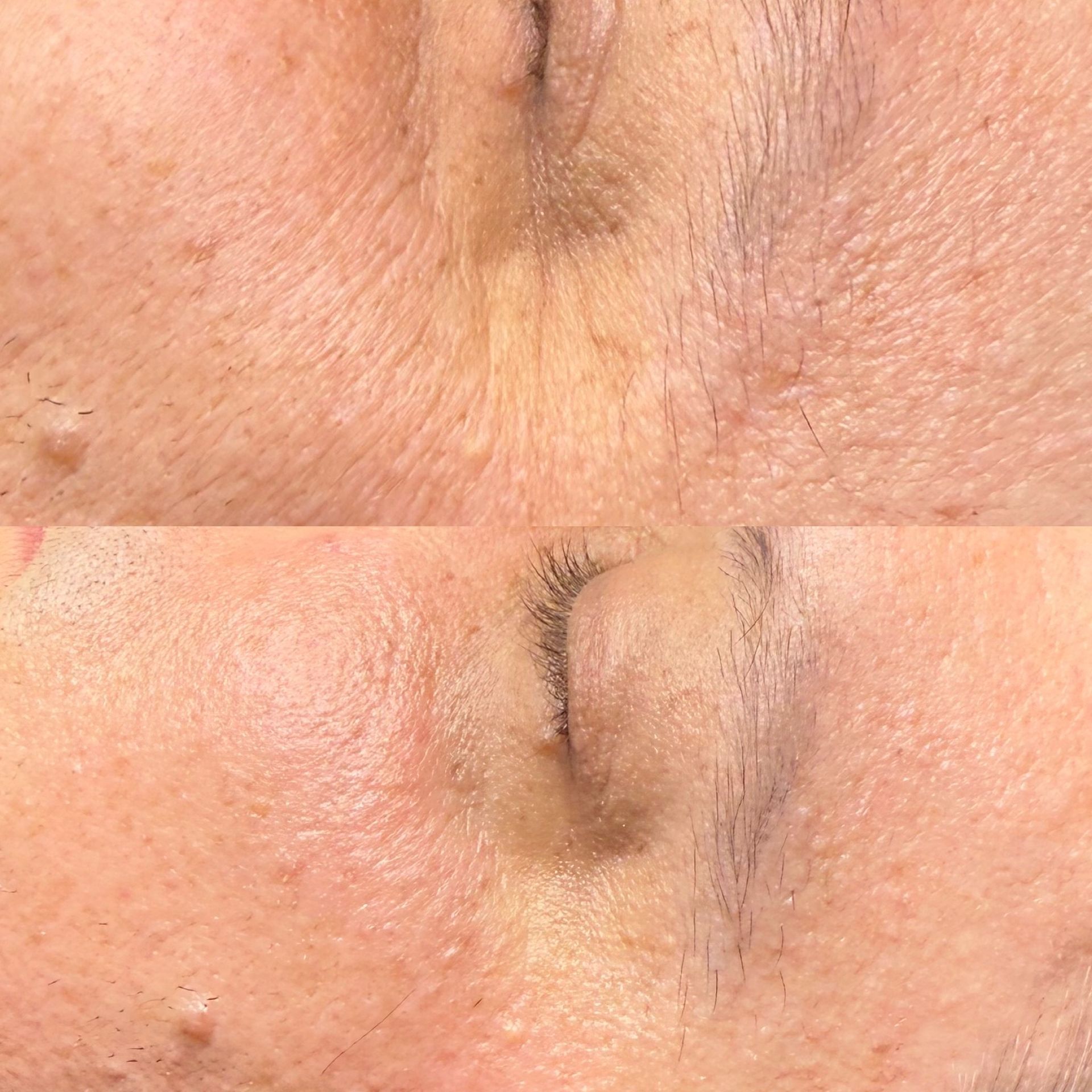 Comparison of skin before and after treatment, showing reduction of wrinkles and blemishes.