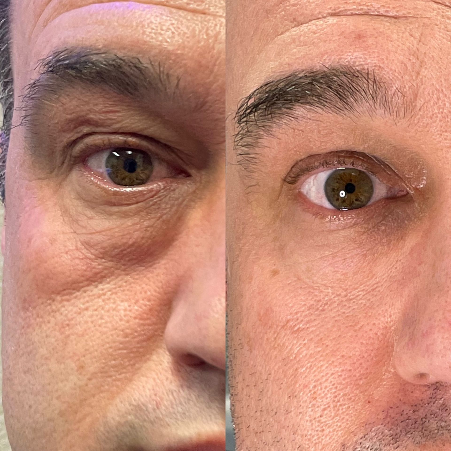 Left side shows puffy eye with wrinkles; right side shows smoother skin after treatment.