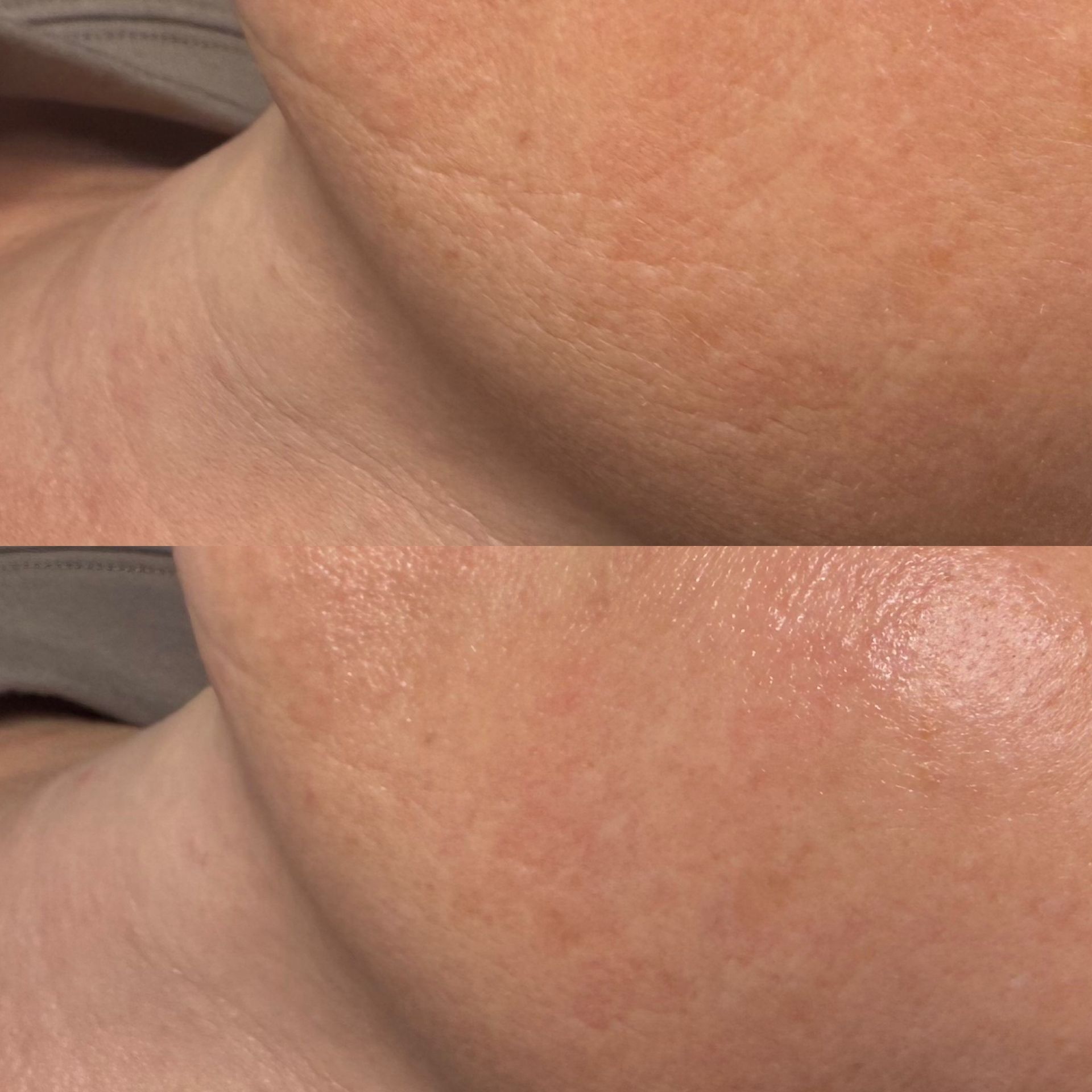 Comparison of neck skin, before (top) and after (bottom) treatment, showing reduced wrinkles and improved texture.