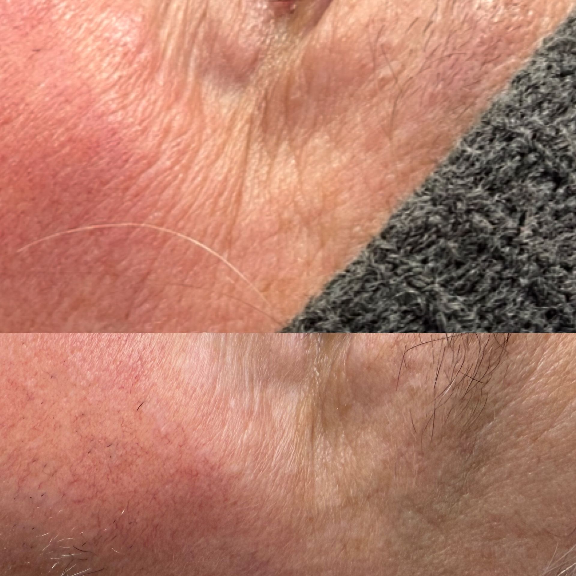 Close-up of human skin before and after a treatment, showing wrinkles and reduced appearance.