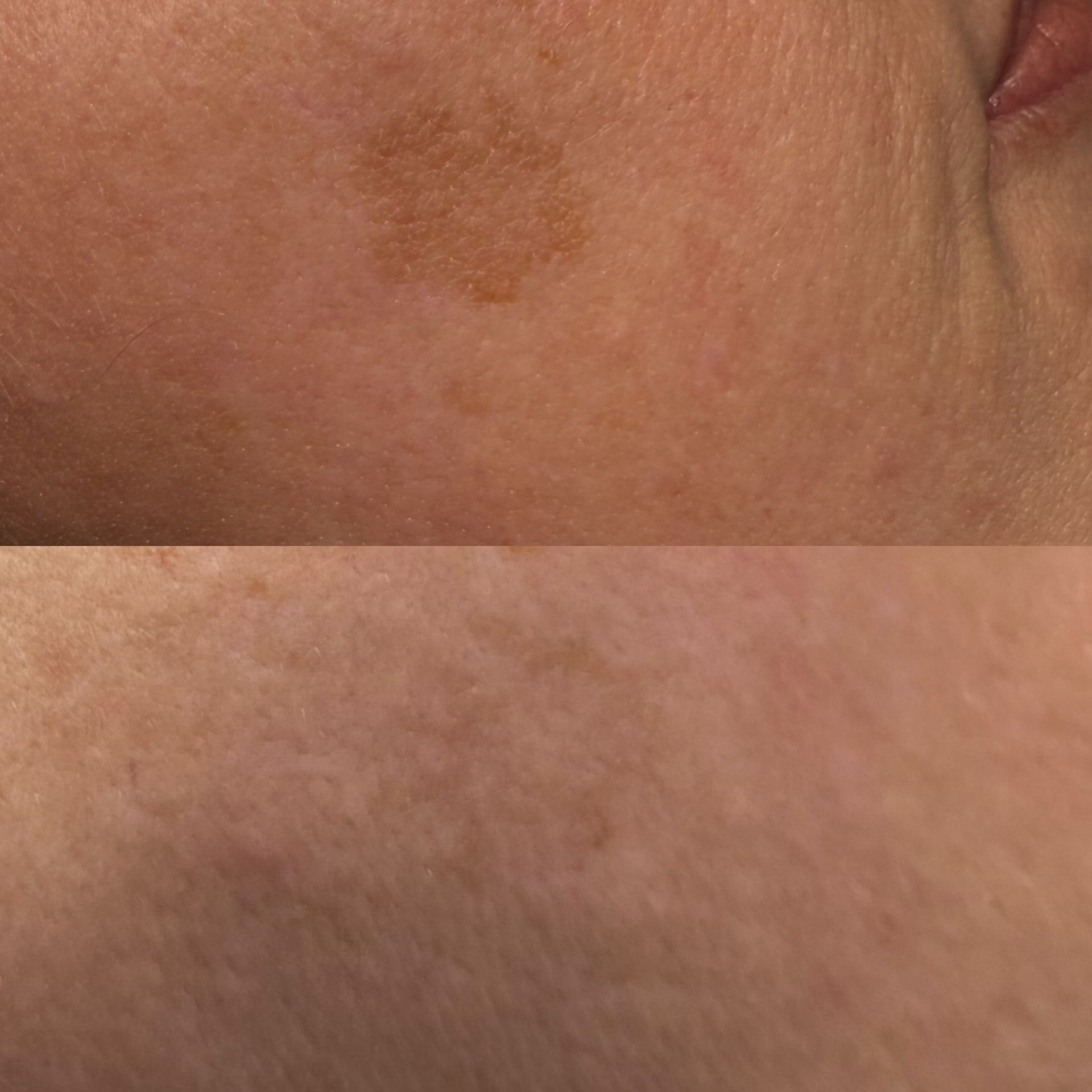 Before and after photos of skin. Top: a brown, circular sunspot. Bottom: skin with fewer spots.