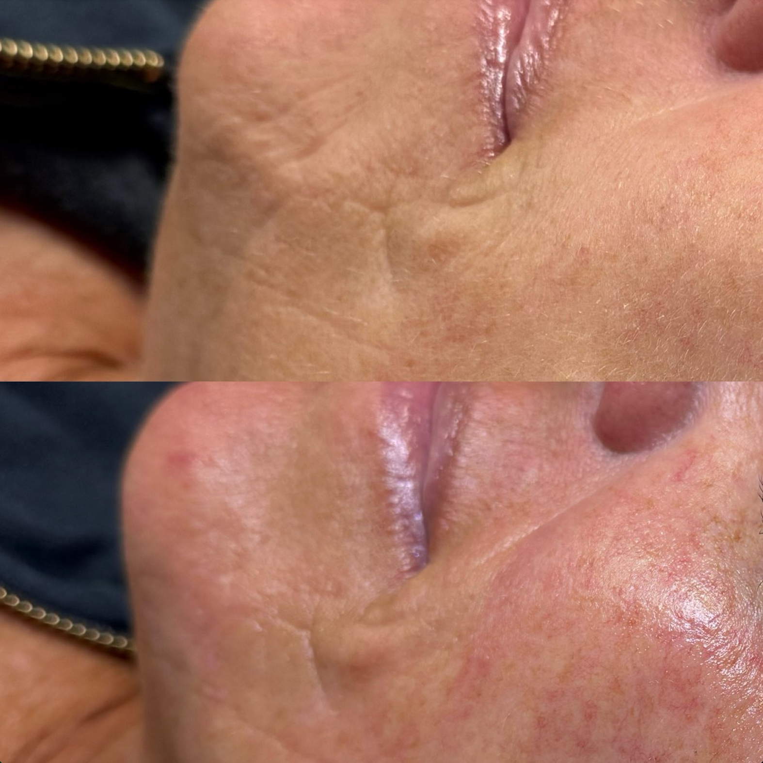 Before-and-after view of facial scar. Top shows scar with textured skin, bottom shows smoother, less visible scar.