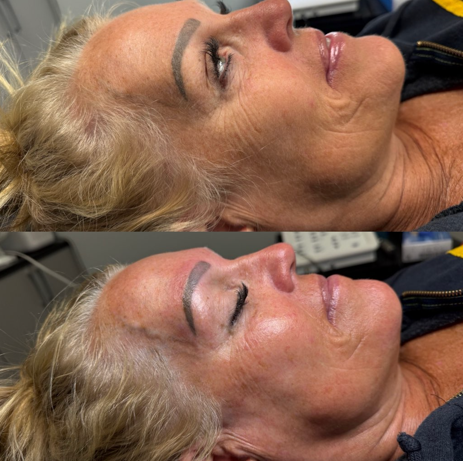 Before and after photos of woman's face, showing reduced wrinkles and smoother skin after a procedure.
