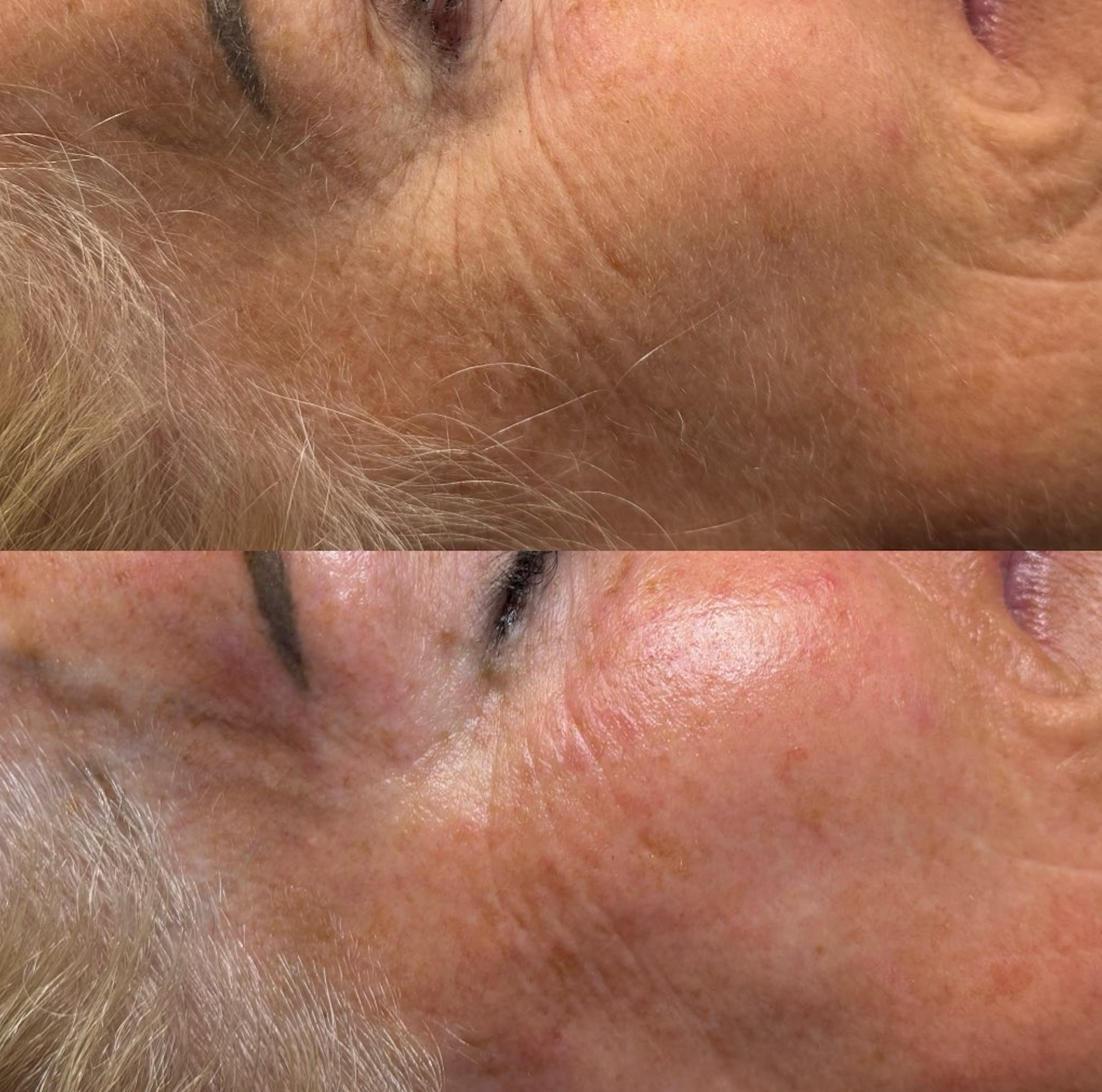 Comparison of mature woman's face, before and after, showing reduction in wrinkles and improved skin tone.