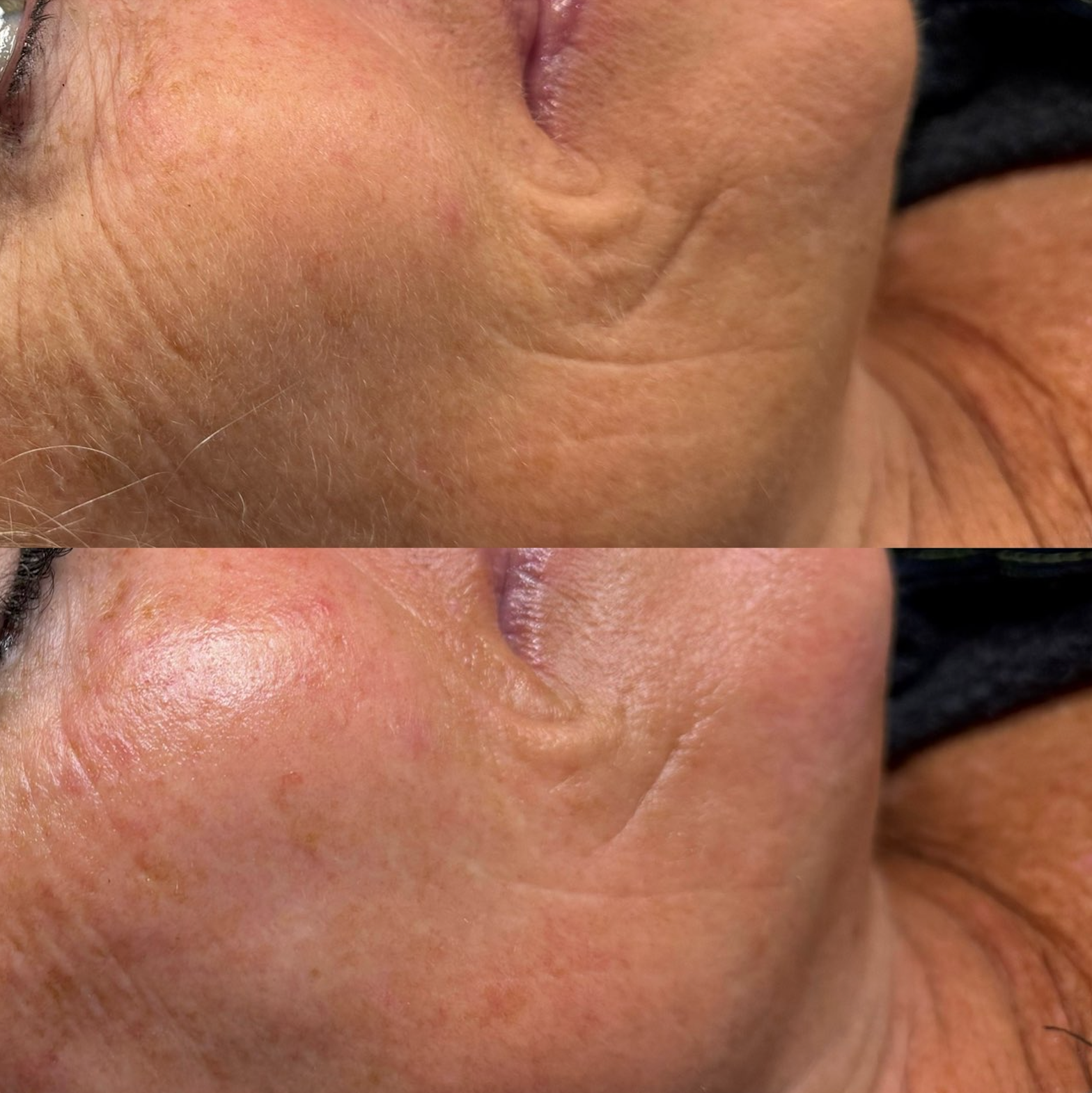 Top: Wrinkled face before. Bottom: Smoother skin after a treatment. Tan skin.