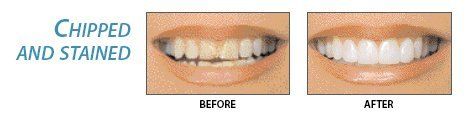 Dental Lumineer Teeth — Chipped And Stained in Greensboro, NC
