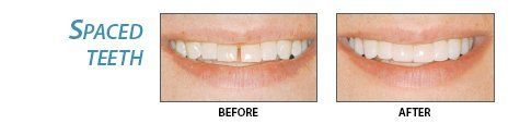 Lumineer Teeth — Spaced Teeth in Greensboro, NC