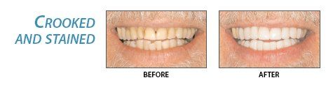 Cosmetic Teeth — Crooked And Stained in Greensboro, NC