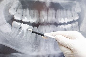 Family Dentistry — Teeth X-ray in Roseville, MI