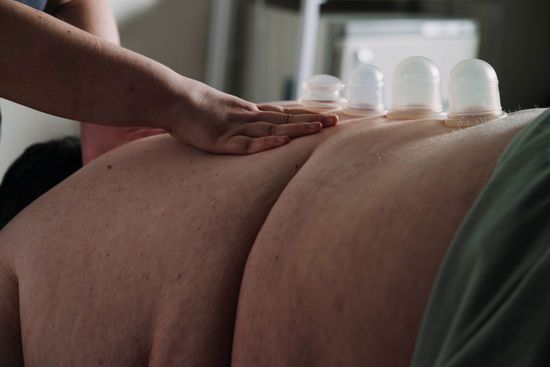 A person is getting a cupping treatment on their back.