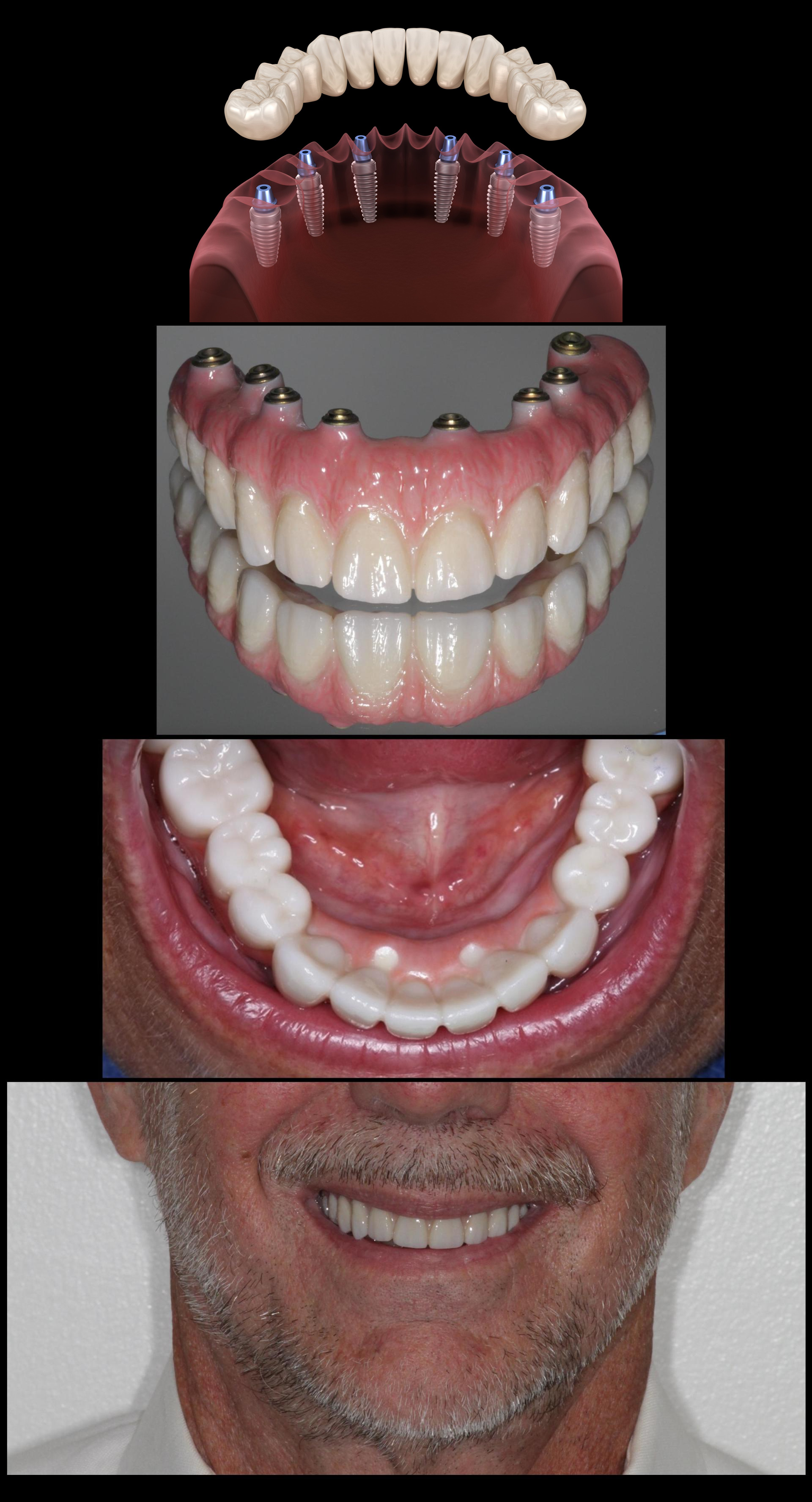 Allon 4 — Dental Implant Pyramid Model in Palm Springs, CA