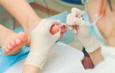 Athlete's foot treatment