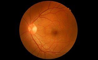 Eye — retina disease treatment in Syracuse, NY