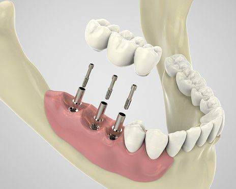 Dental Bridge — Installation of Dental Implants in Florence, SC