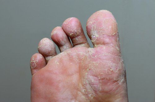 Athlete's Foot Cracks In Feet Reasons Athlete's Foot Crack