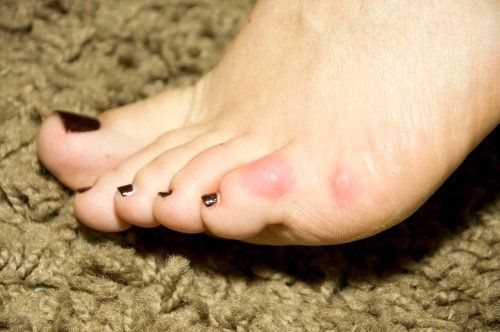 Callus removal from feet + small seed corn 