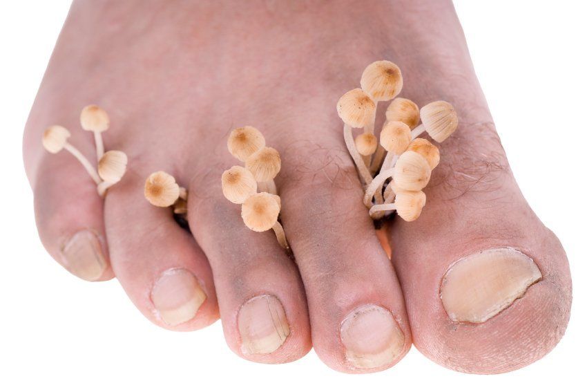 athlete-s-foot-fungal-nail-infection-procare-podiatric-medicine