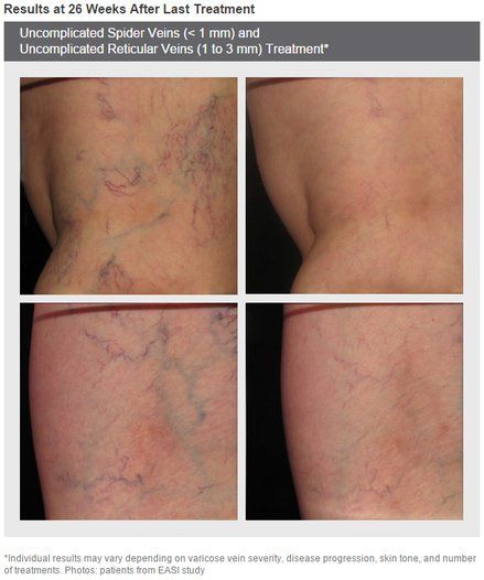 spider vein treatment