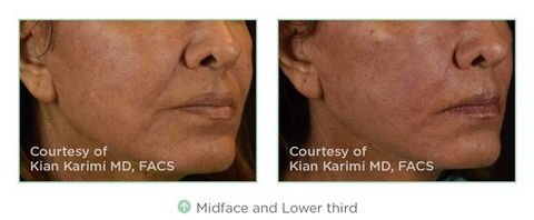 before and after of midface thread treatment
