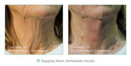 before and after of sagging neck treatment