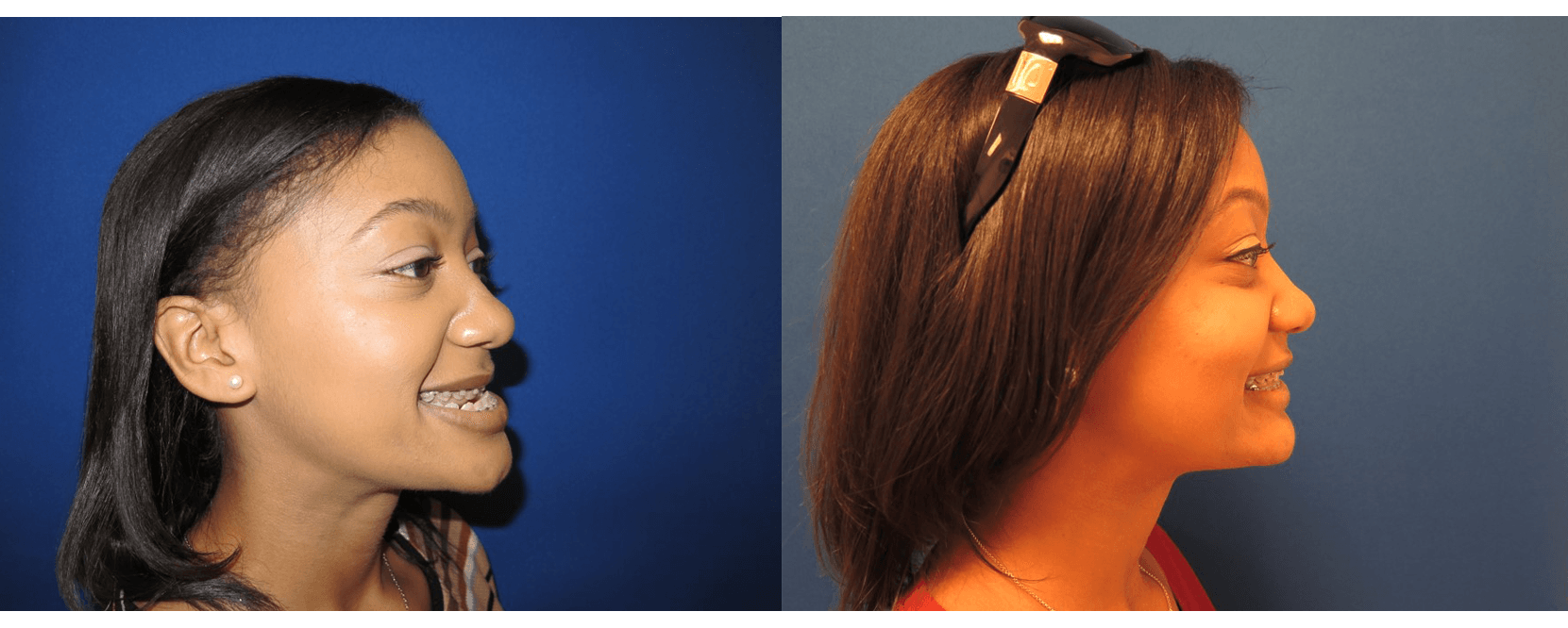 Orthognathic Surgery