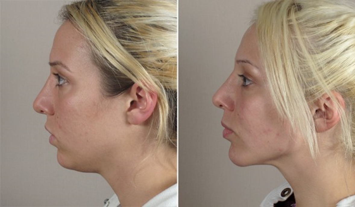 Chin Augmentation