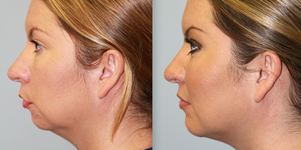 Chin Augmentation