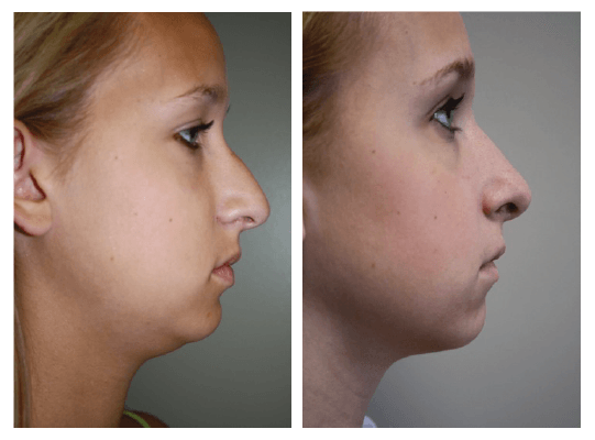 A before and after photo of a woman 's face.