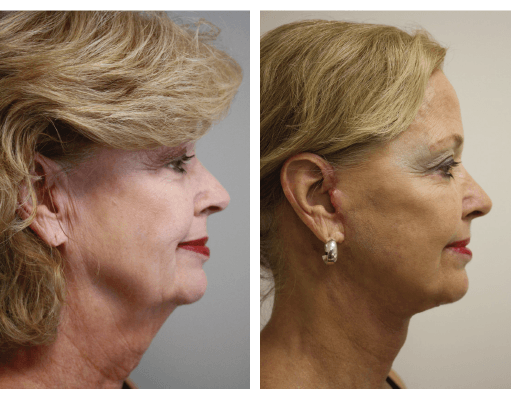 A before and after photo of a woman 's face and neck.