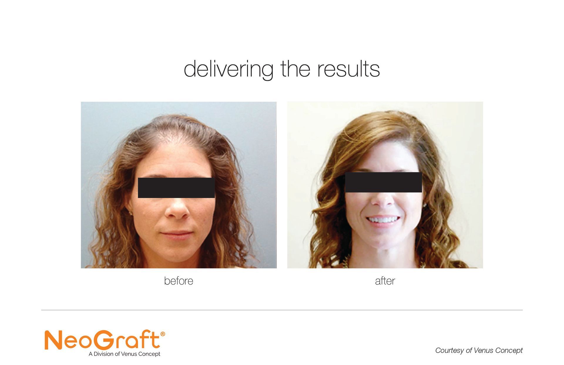 A before and after photo of a woman 's hair growth.