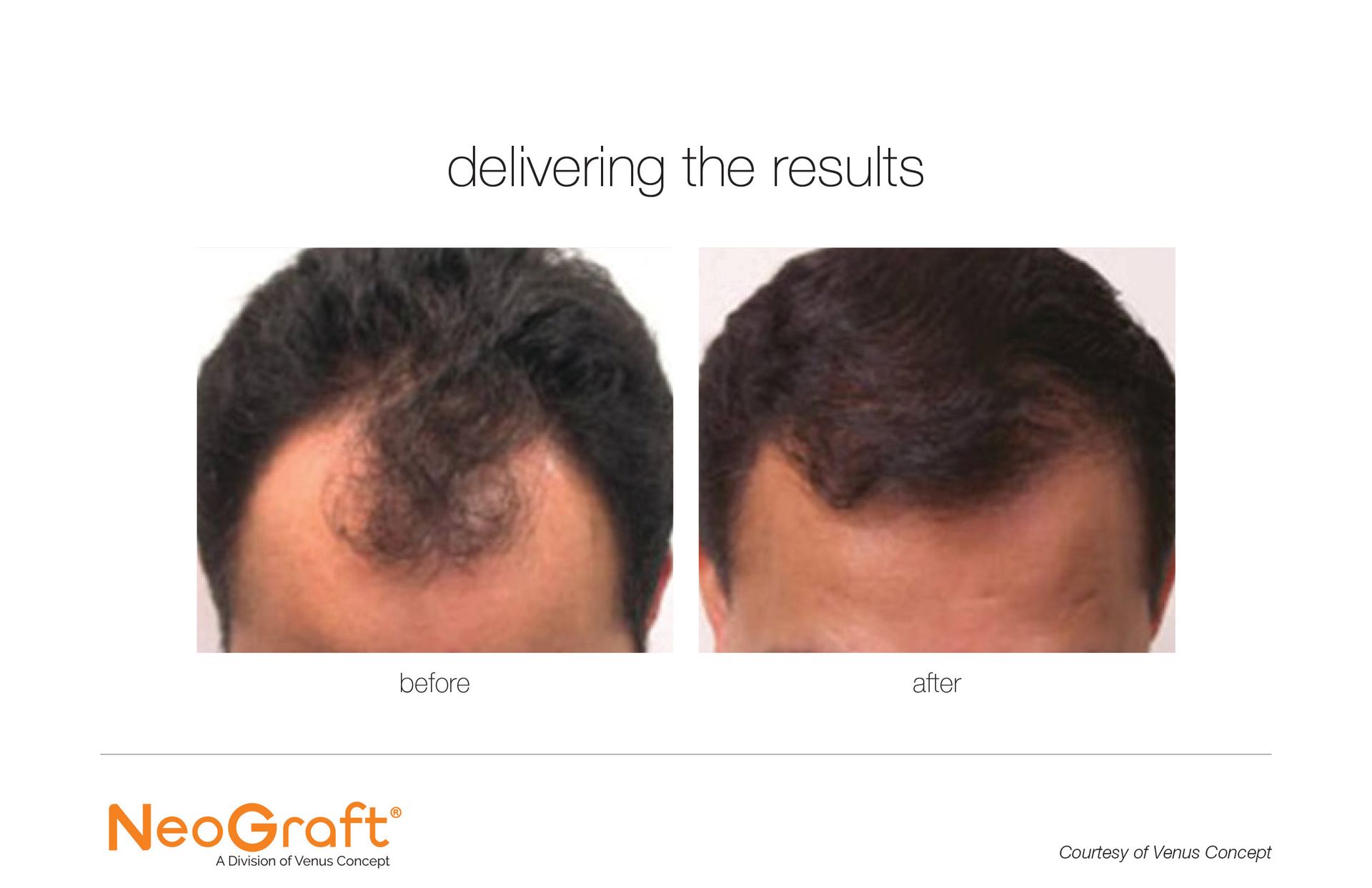 A before and after picture of a man 's hair growth