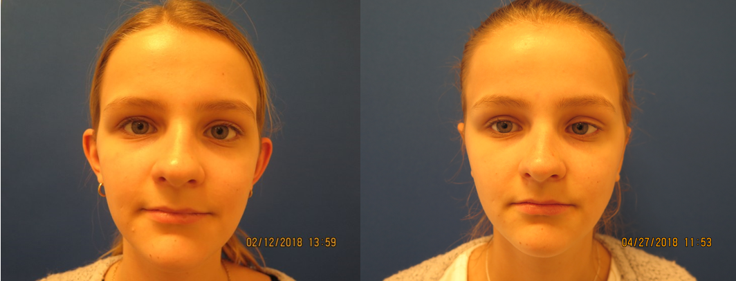 A before and after photo of a woman 's face.