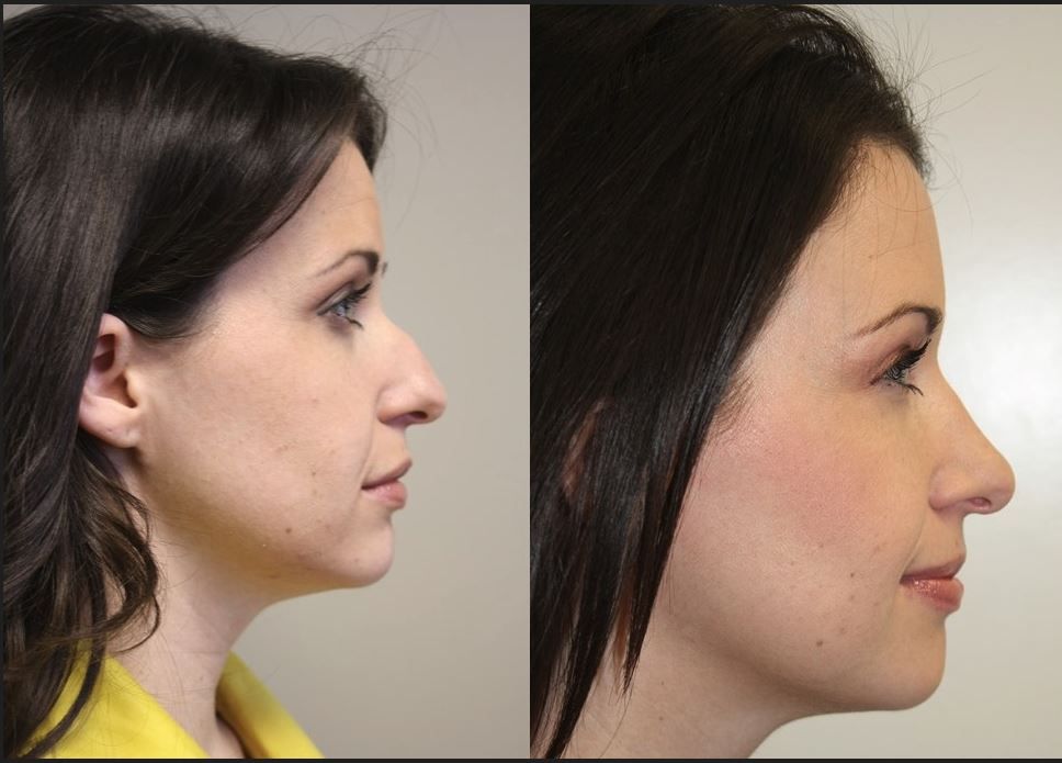 rhinoplasty