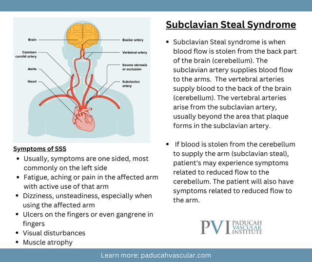Subclavian Artery Stenosis Icd