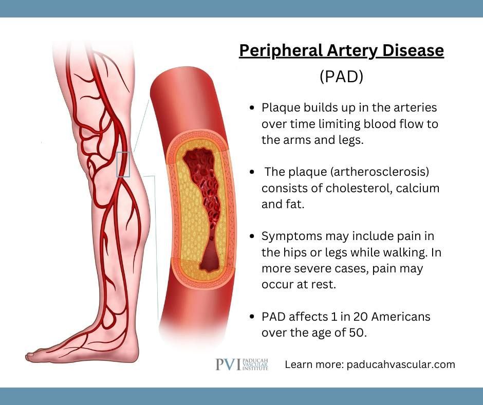 Peripheral artery disease ( pad ) is a disease that affects 1 in 20 americans over the age of 50.